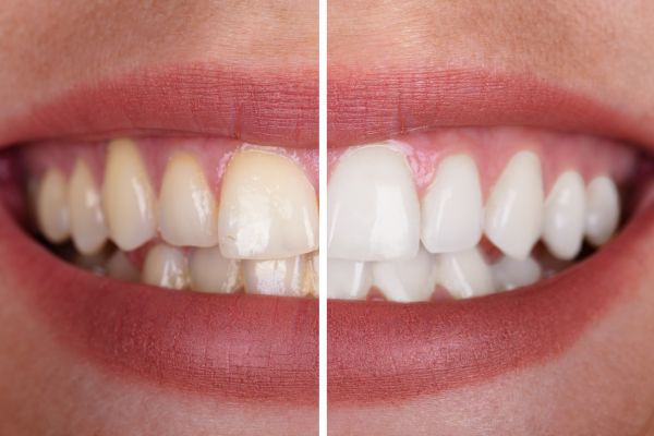 -2- blanchiment dentaire - Dentisterie Sourire a Marieville